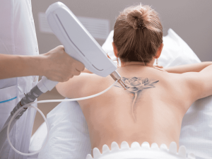 Laser Tattoo Removal: Erasing Ink Mistakes with Precision