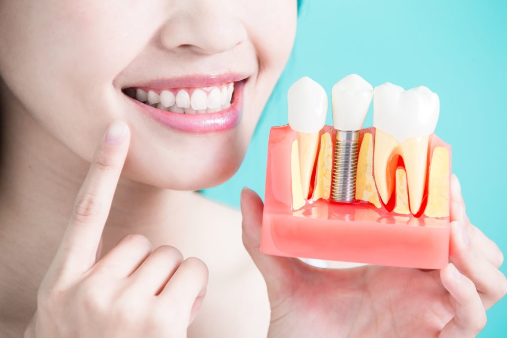 How Long Do Dental Implants Last? Understanding Their True Lifespan