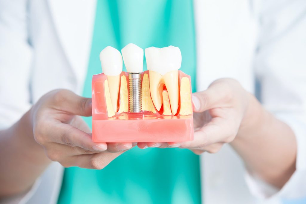 Why Are Dental Implants So Expensive?