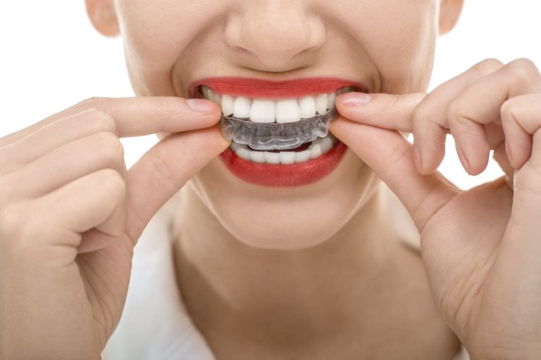 Invisalign Tips for Students in Waterloo, Ontario