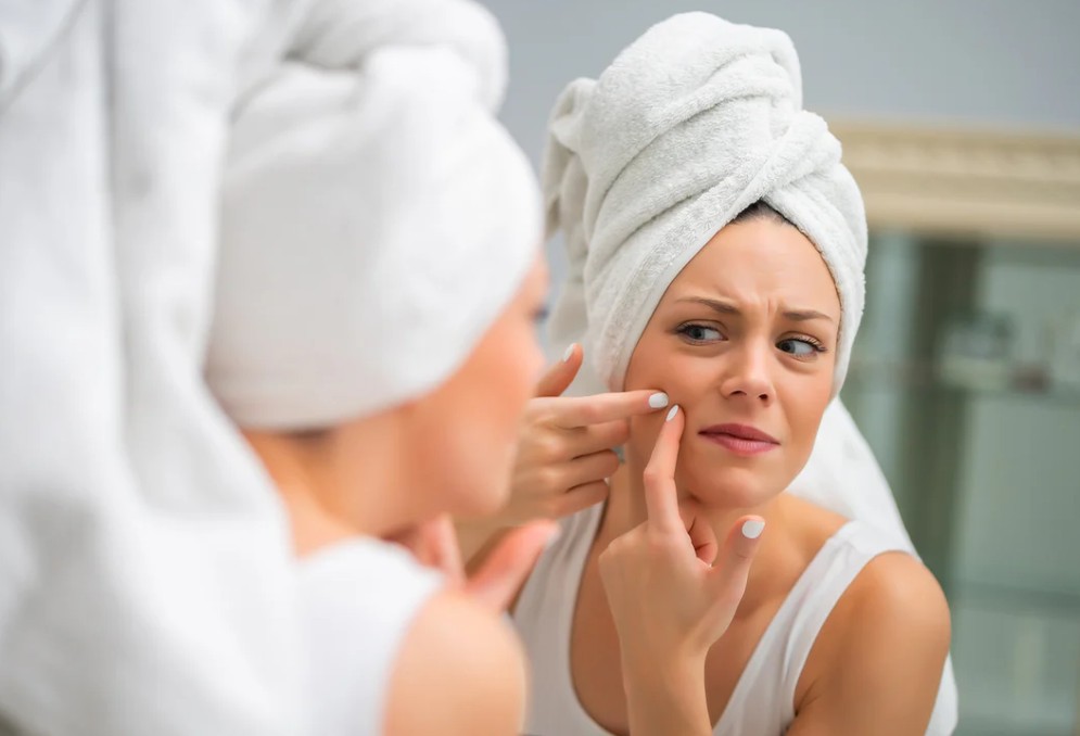 A Complete Guide to Managing Body Acne Treatment in Singapore for Clearer and Healthier Skin